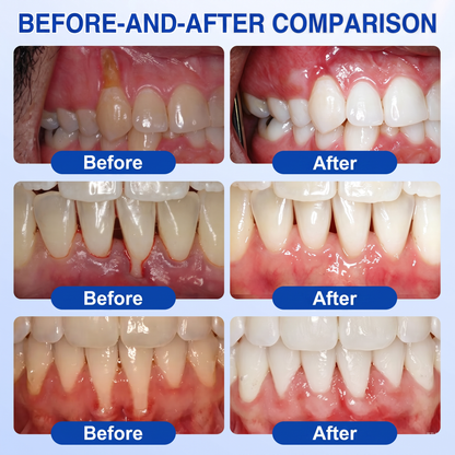 Pureluxo® 🦷  periodontal repair gel 🧑‍⚕️