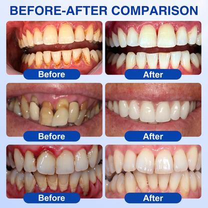 Pureluxo® 🦷  periodontal repair gel 🧑‍⚕️