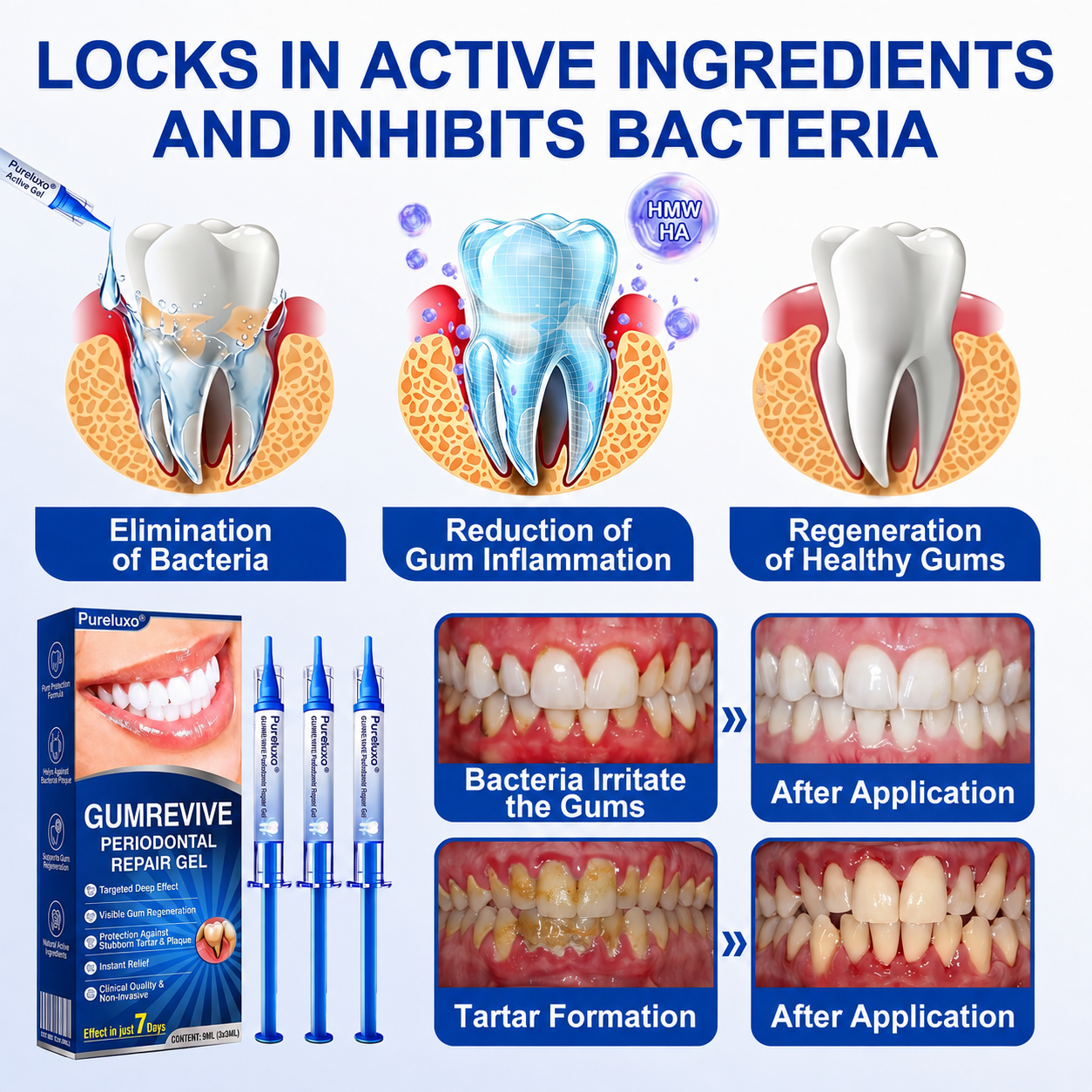Pureluxo® 🦷  periodontal repair gel 🧑‍⚕️